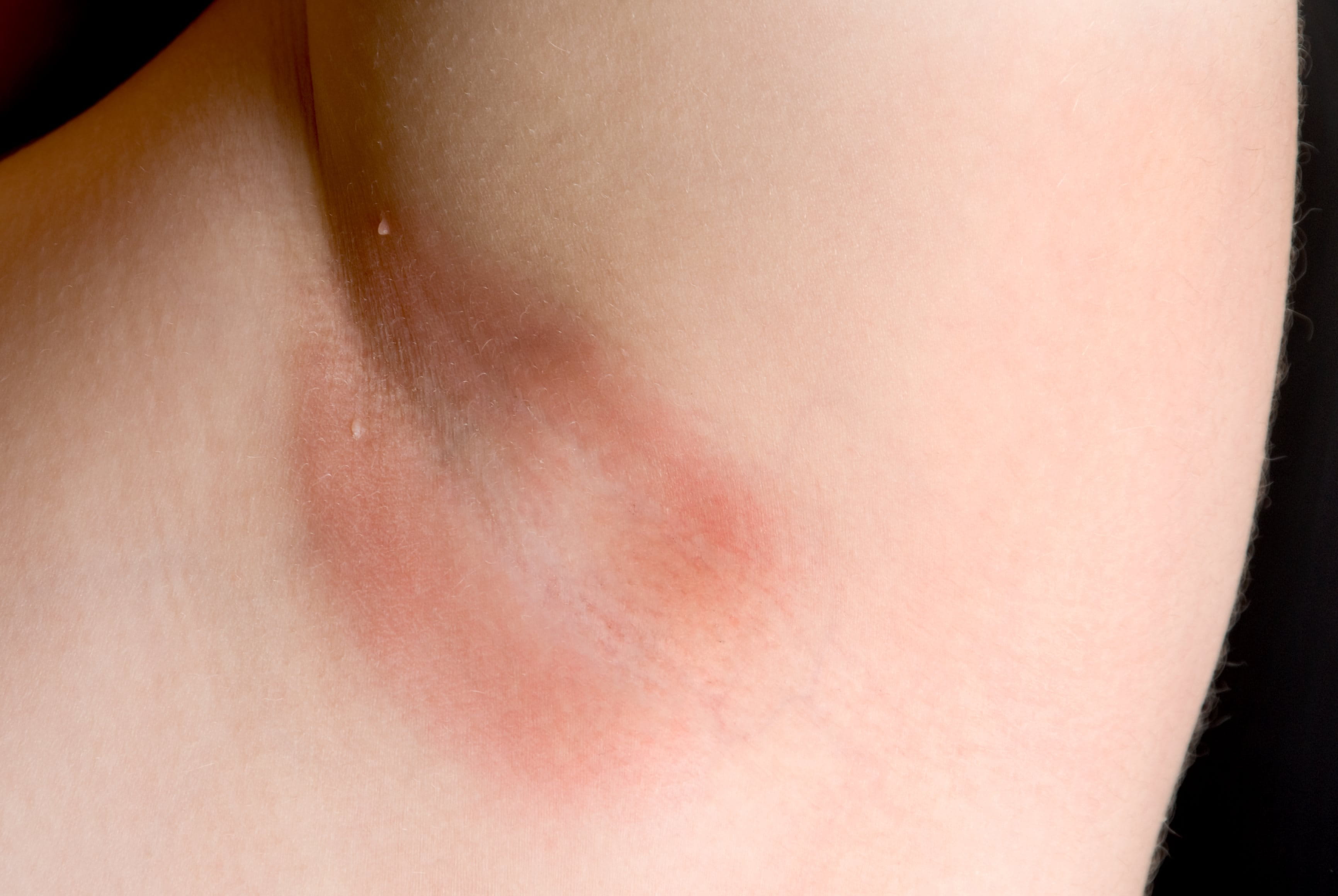 Psoriasis inversa in einer Achselhöhle