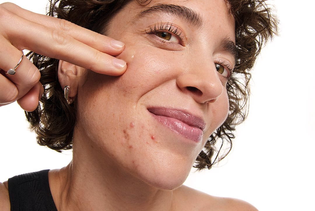 face of woman with acne on cheek