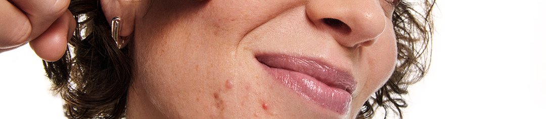 A woman touching her acne on cheecks