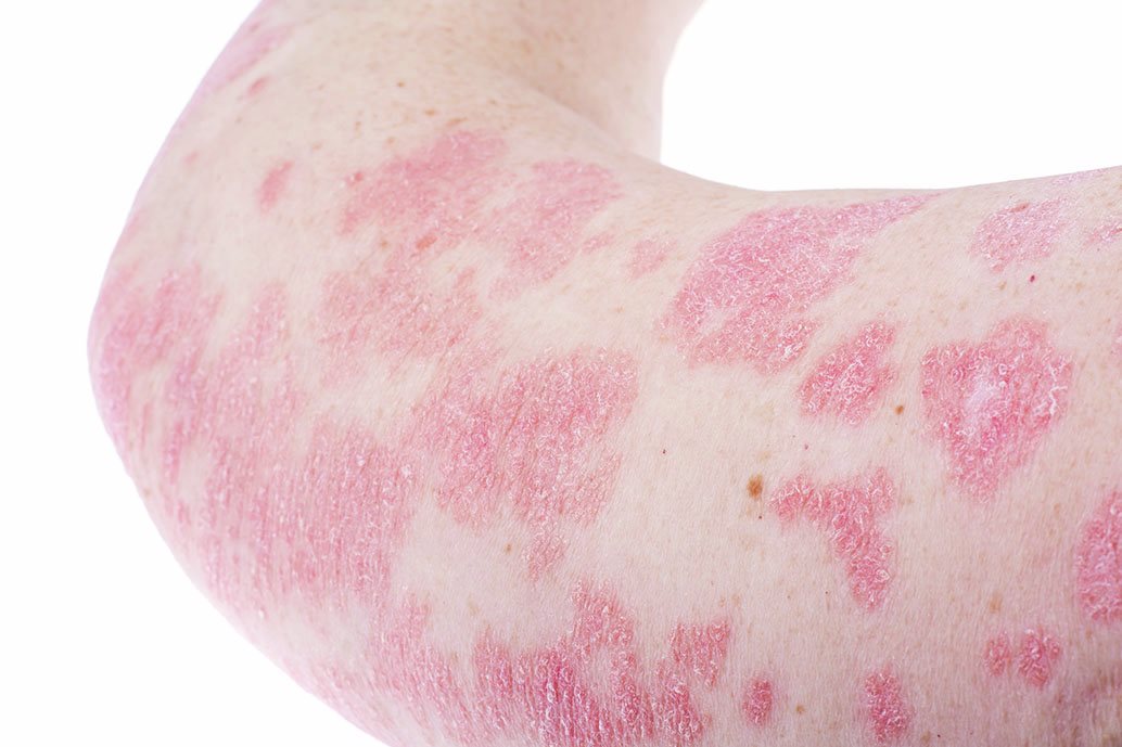 Dettaglio di placche arrossate e desquamate sul braccio causate da psoriasi pustolosa in fase attiva