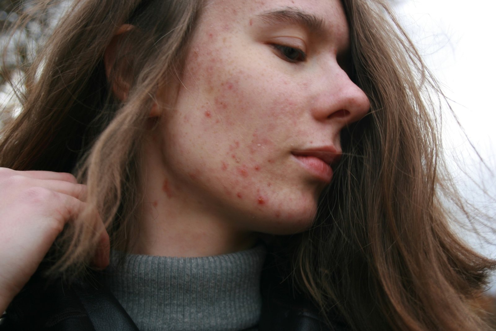 A woman with blemishes on the face