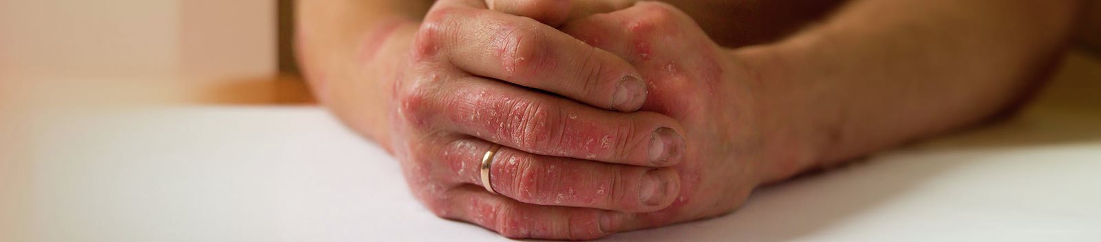 Mani con lesioni infiammate, arrossate e desquamate, sintomo visibile di psoriasi pustolosa palmare