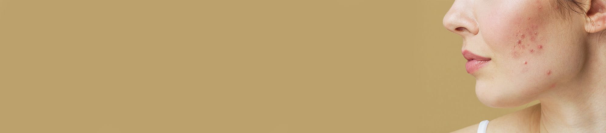 foto di ragazza con pelle del viso acneica