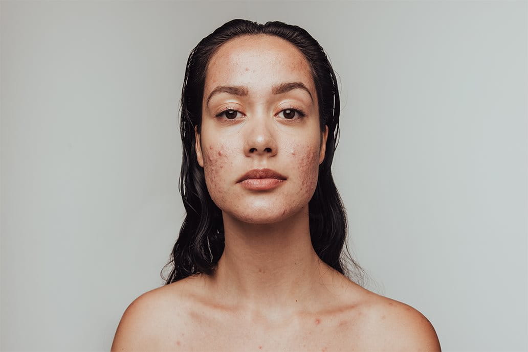 acne sulle guance