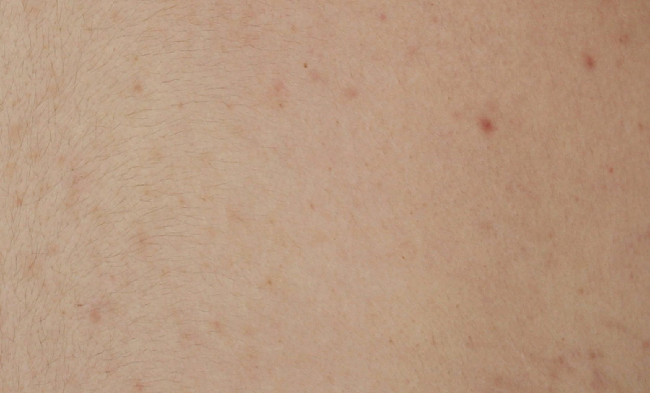 A picture of clean skin and reduced appearance of acne prone skin after using Eucerin DERMOPURE CLINICAL Correcting Body Cream