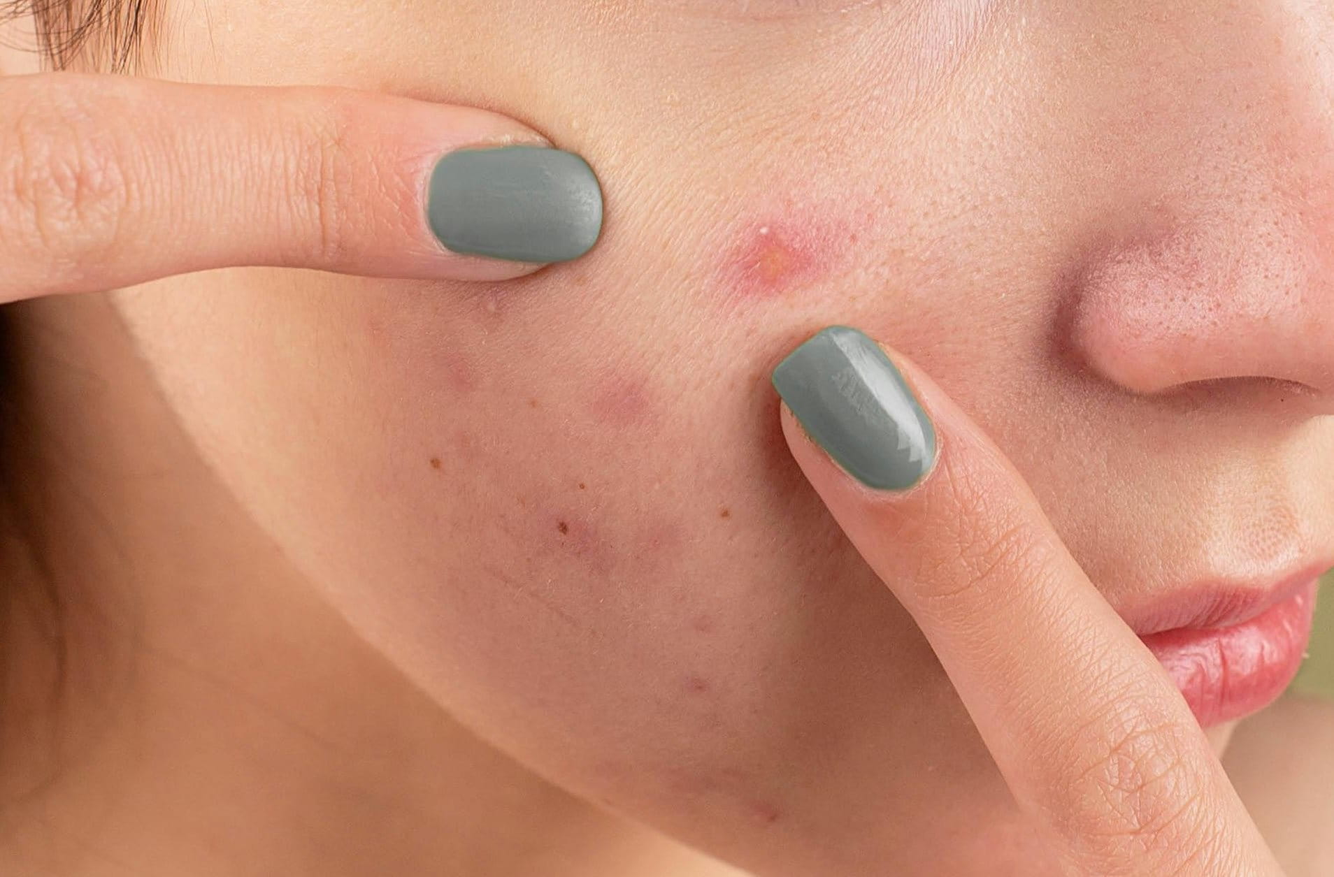 Junge Frau drückt einen Pickel an ihrer Wange aus – Nahaufnahme des Gesichts mit sichtbaren Hautunreinheiten.