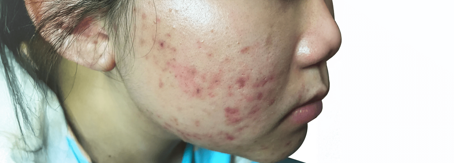 Understanding Acne and How to Care for Acne-Prone Skin
