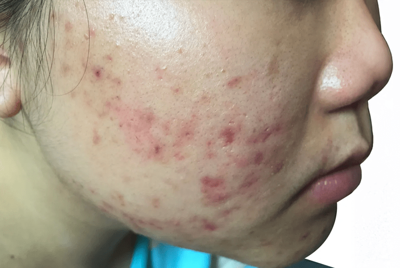 Understanding Acne and How to Care for Acne-Prone Skin