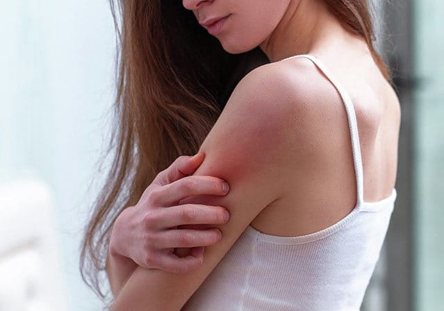 Donna si gratta la parte superiore del braccio arrossata, sintomo visibile di candidosi cutanea