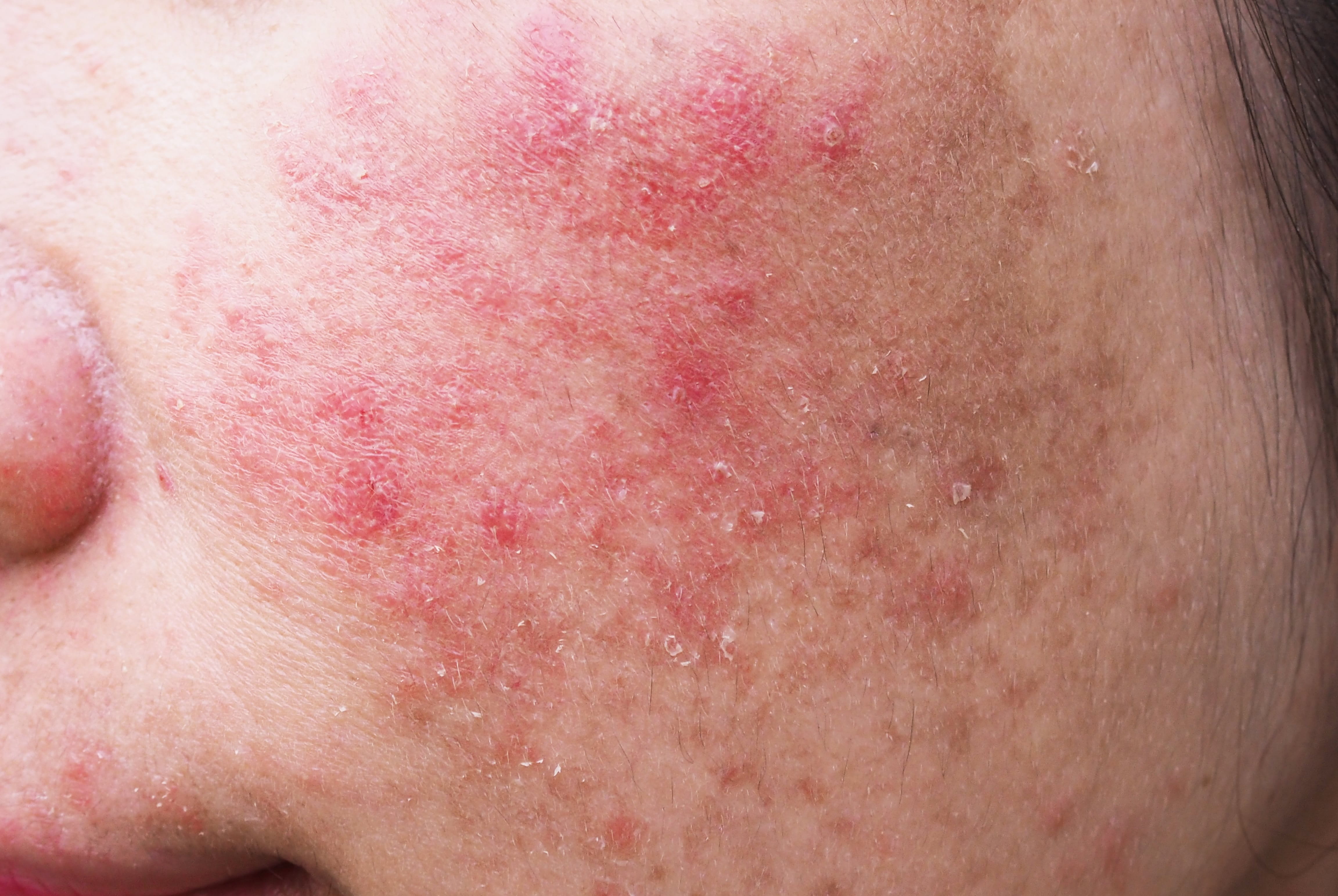 Humidity, Sensitive Skin and Why It Matters