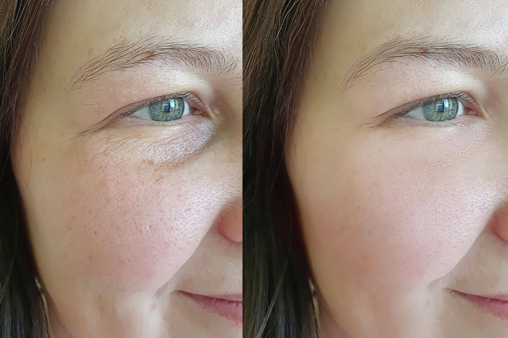 primo piano di un volto femminile in un confronto prima e dopo l’applicazione di un trattamento al retinolo