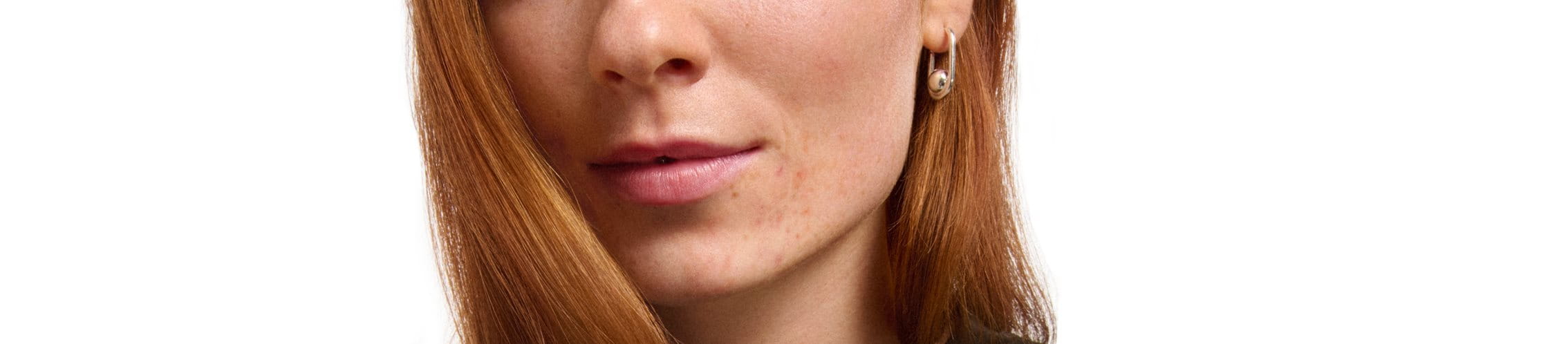 A woman with blackheads whiteheads