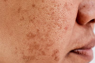 Melasma im Gesicht