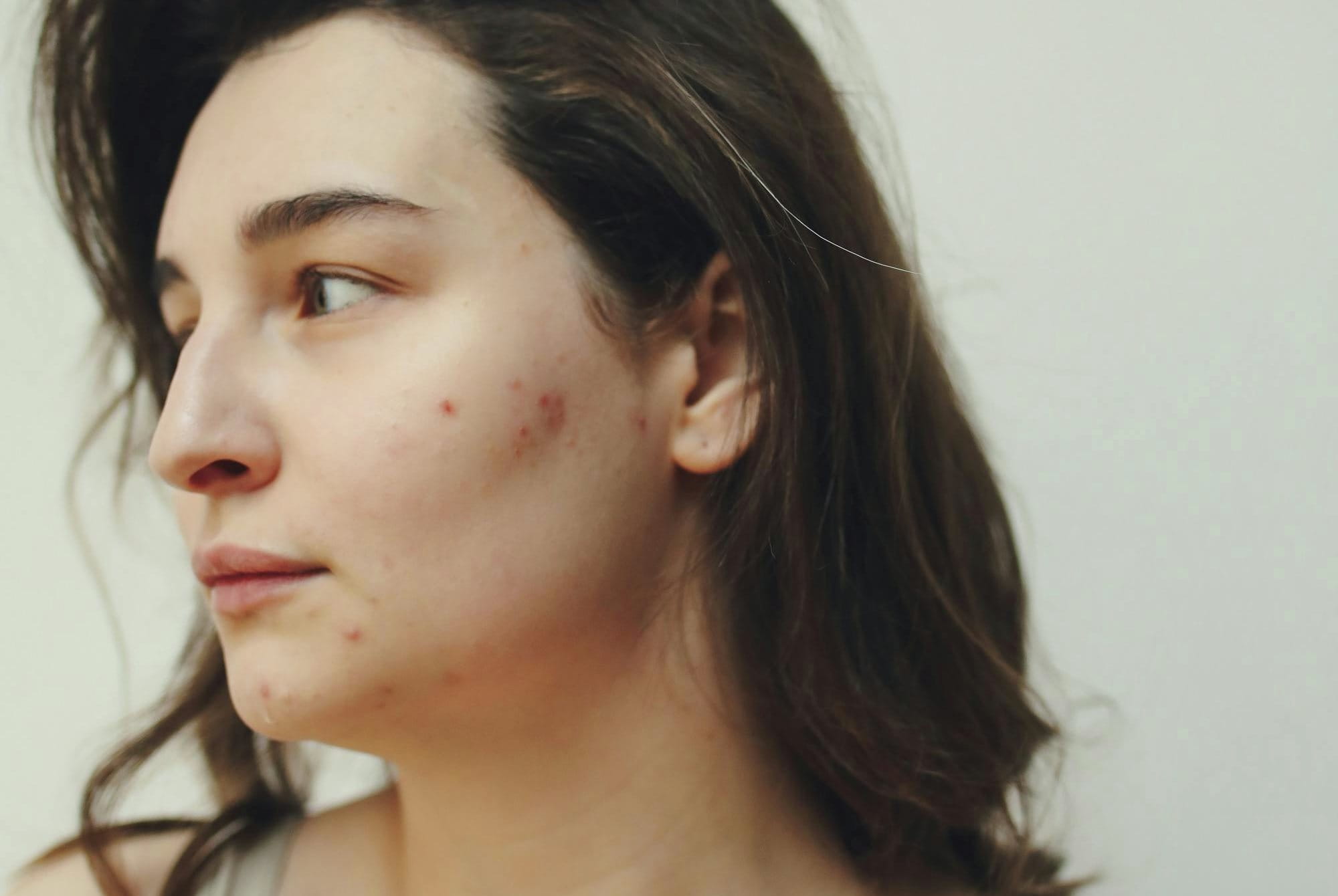 Detailaufnahme einer Frau mit entzündeten und teilweise geöffneten Pickeln an der Wange und am Kinn.