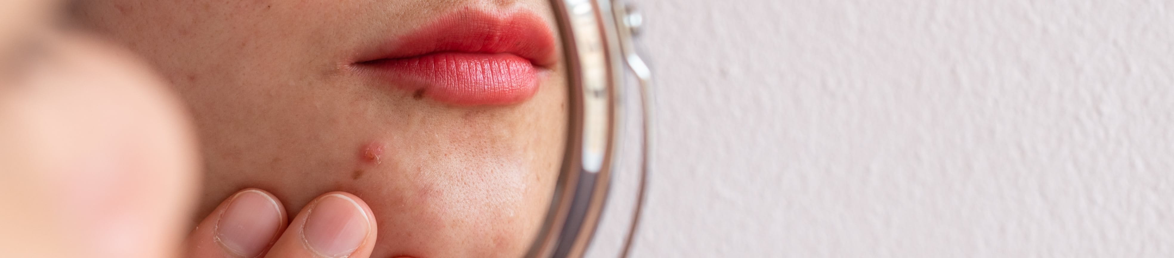 Spiegelbild der unteren Gesichtspartie einer Frau, die mit ihrem Finger einen Pickel am Kinn betastet.