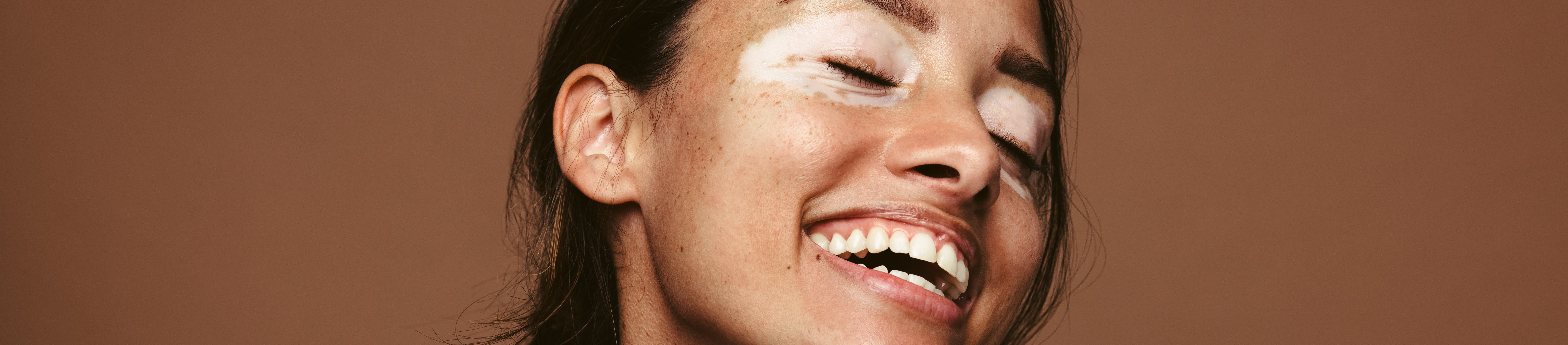 Hypopigmentatie treedt op wanneer de huid minder melanine produceert dan normaal.