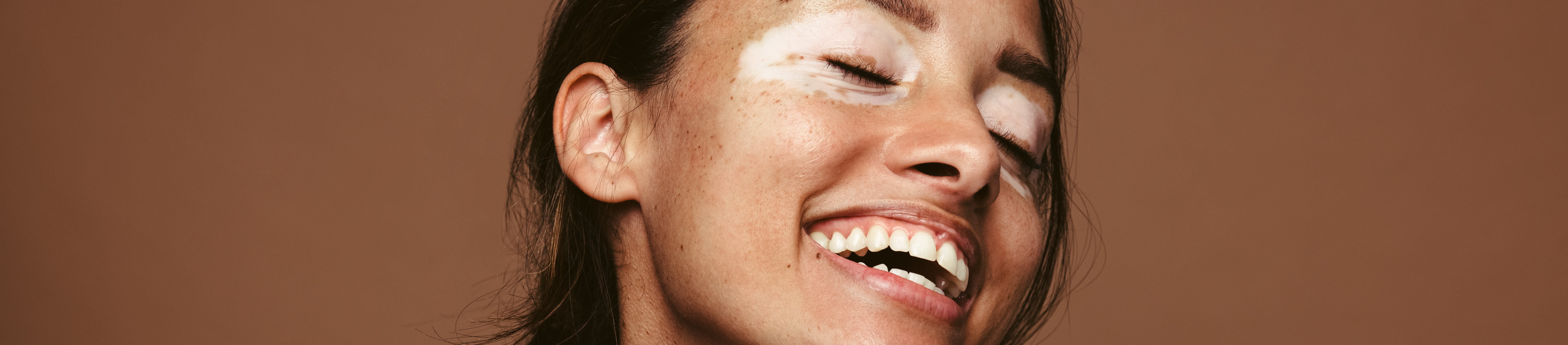 L'hypopigmentation survient lorsque la peau produit une quantité de mélanine inférieure à la normale.