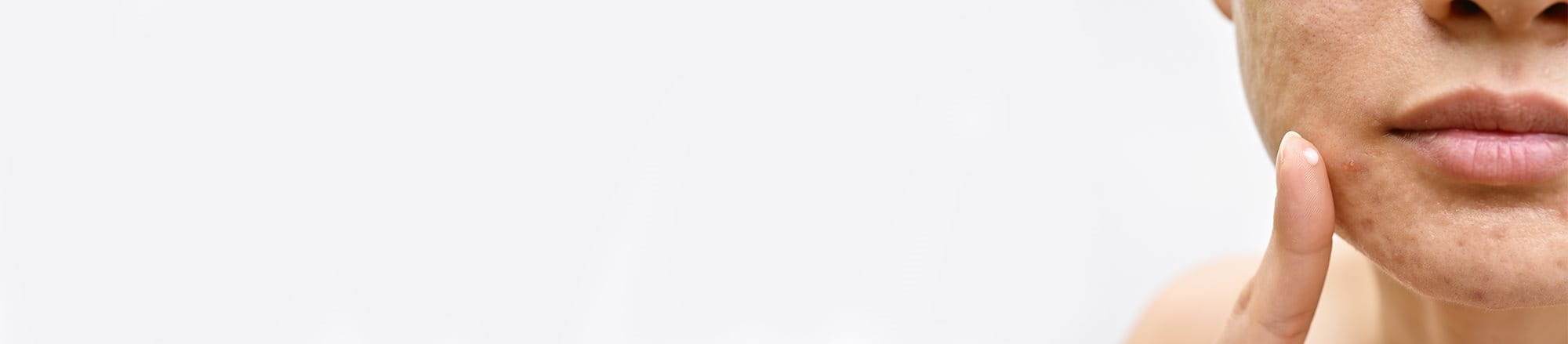 Donna con segni di acne sulla pelle applica crema topica sul mento come trattamento