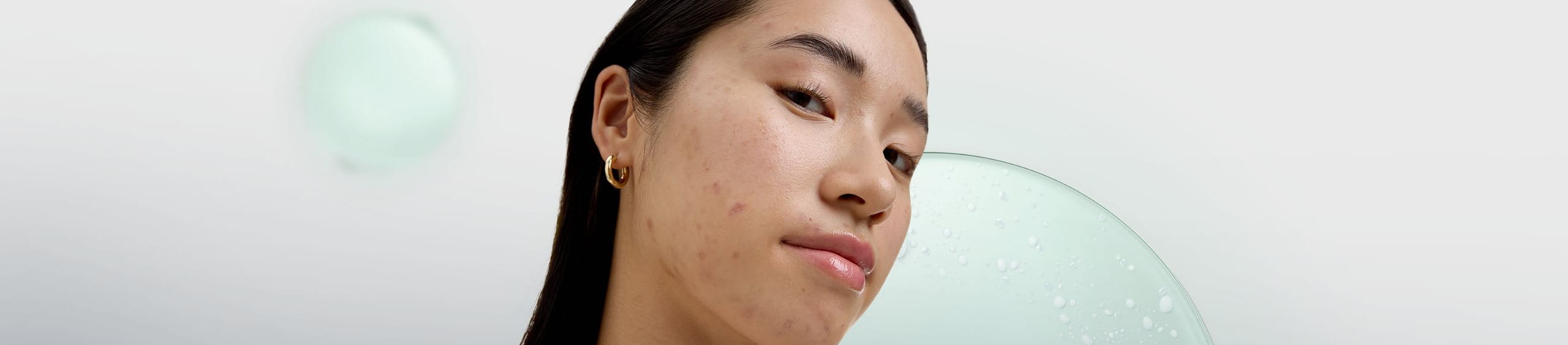 Persona conociendo los tratamientos del acné adolescente