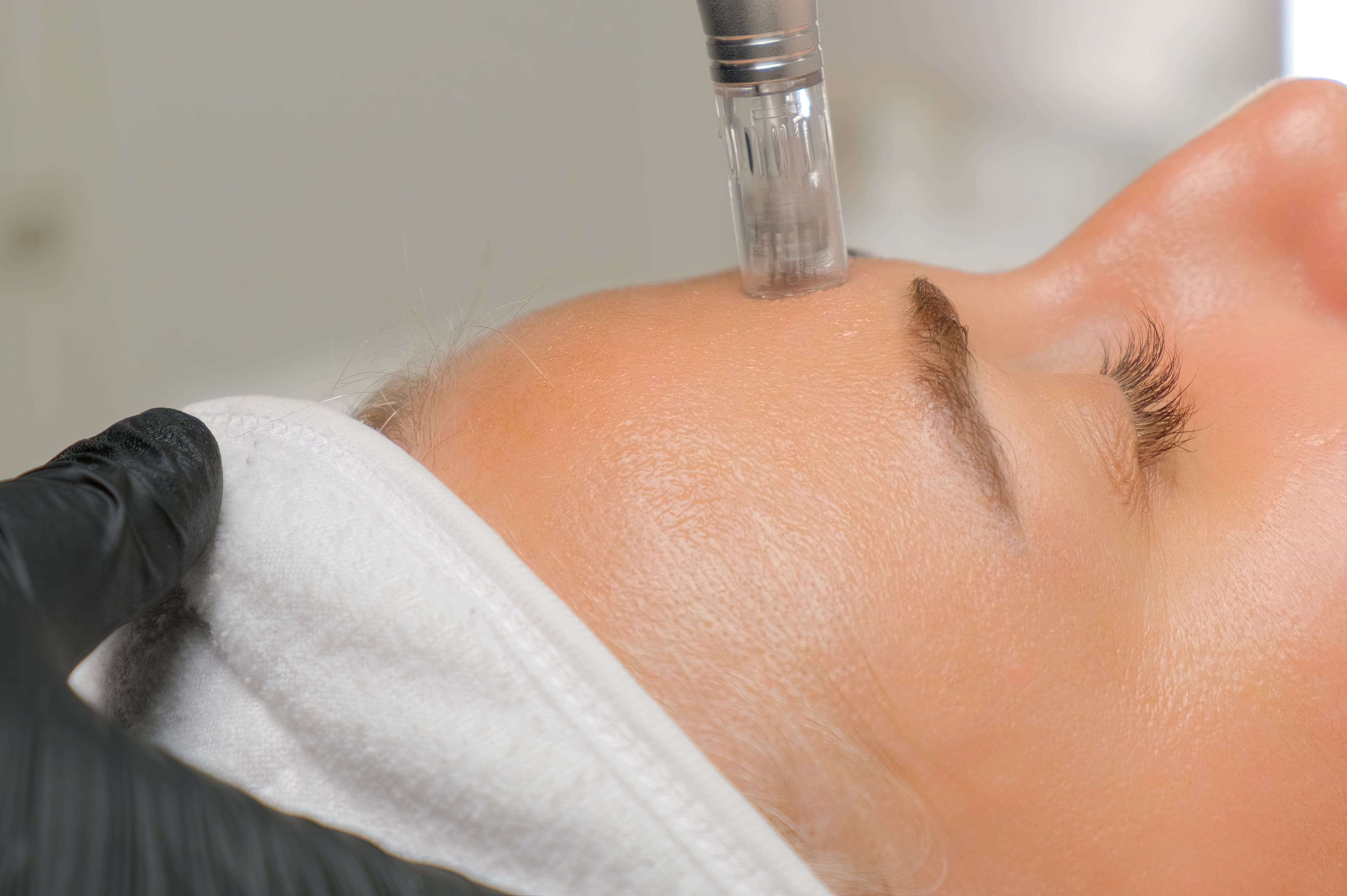 Nahaufnahme einer kosmetischen Microdermabrasion-Behandlung im Gesicht einer Frau.