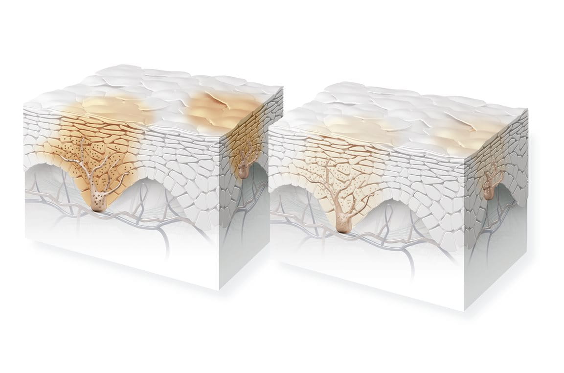 Schematische Darstellung der Epidermis mit einer Anhäufung von Melanozyten unten und dunklen Hautflecken oben.
