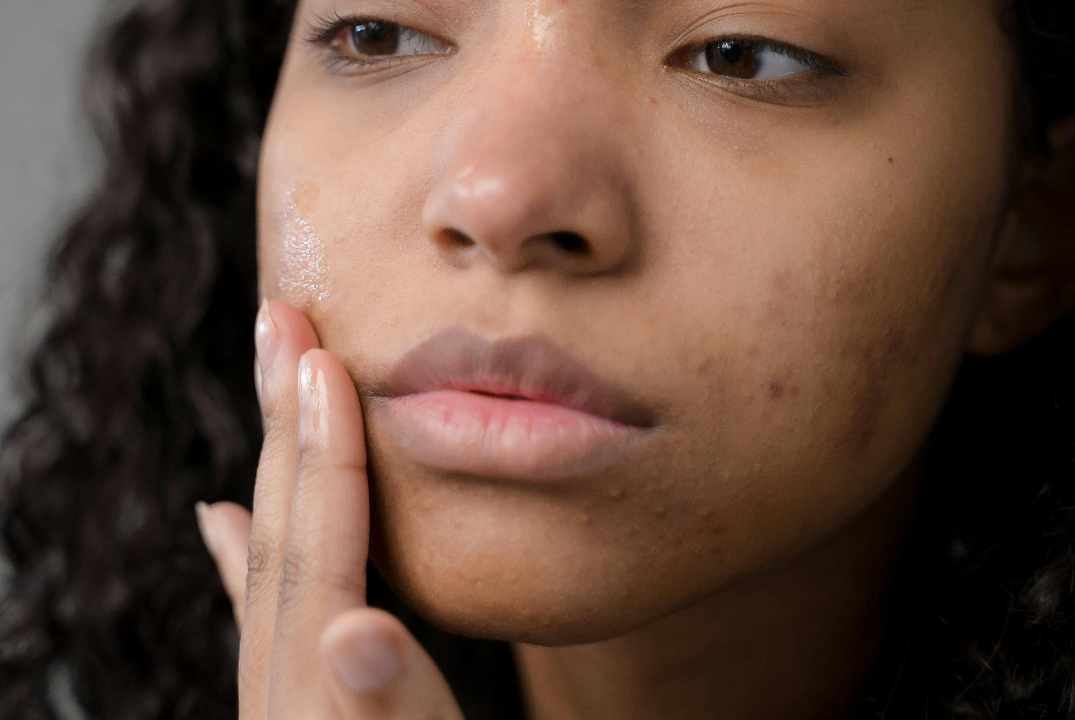 Junge Frau trägt ein Serum auf ihre Wangen auf, um dunkle Pickelmale zu entfernen