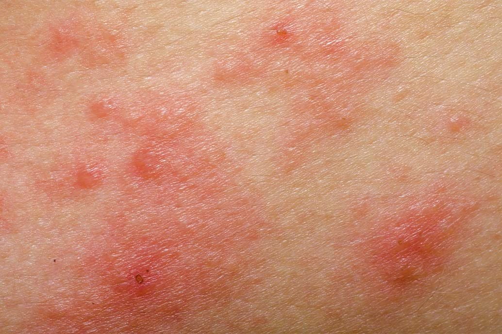 foto di pelle acneica