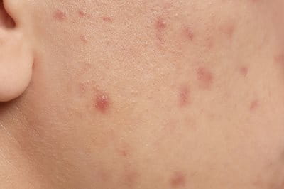 Postinflammatorische Hyperpigmentierung (PIH)
