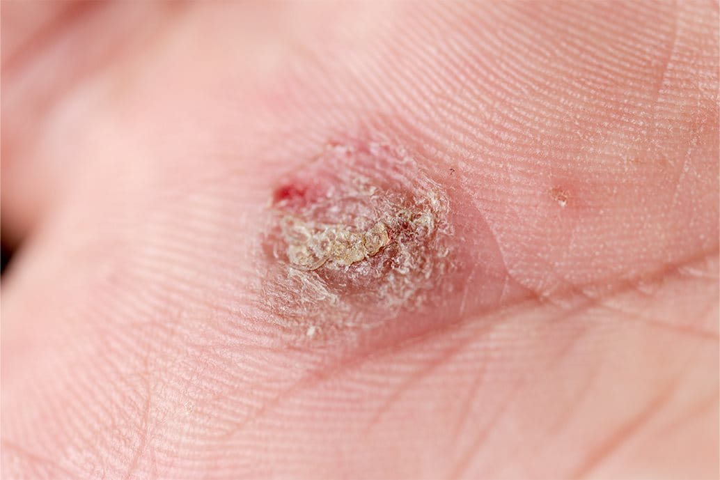 cheratoacantoma crosta: immagine di un cheratoacantoma infiammato con la crosta