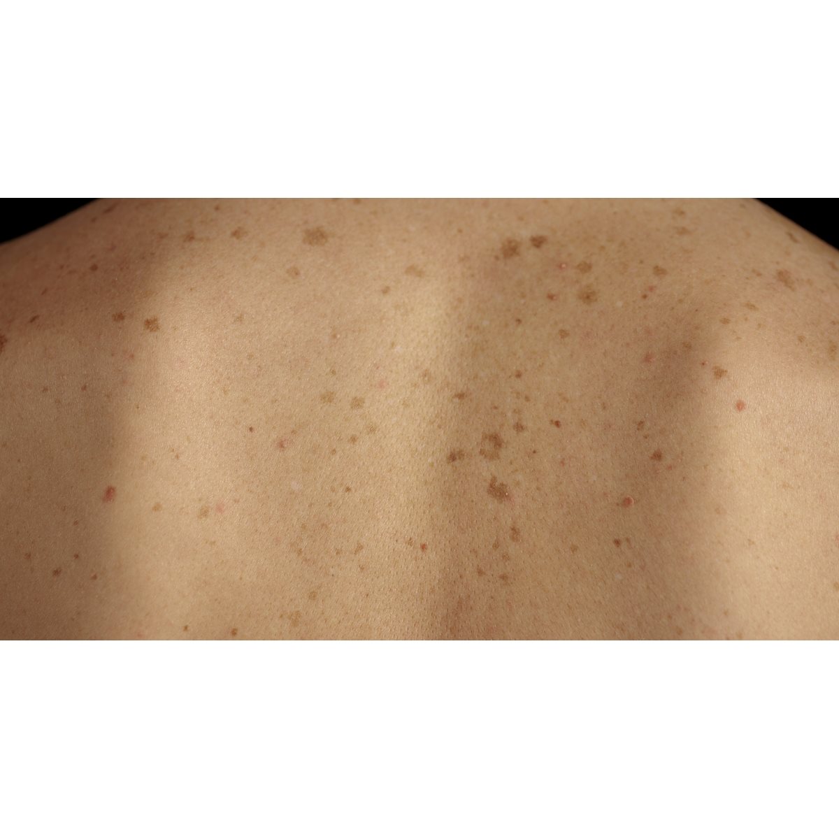 Rücken einer Person mit zahlreichen Pigmentflecken und Sommersprossen auf der Haut.