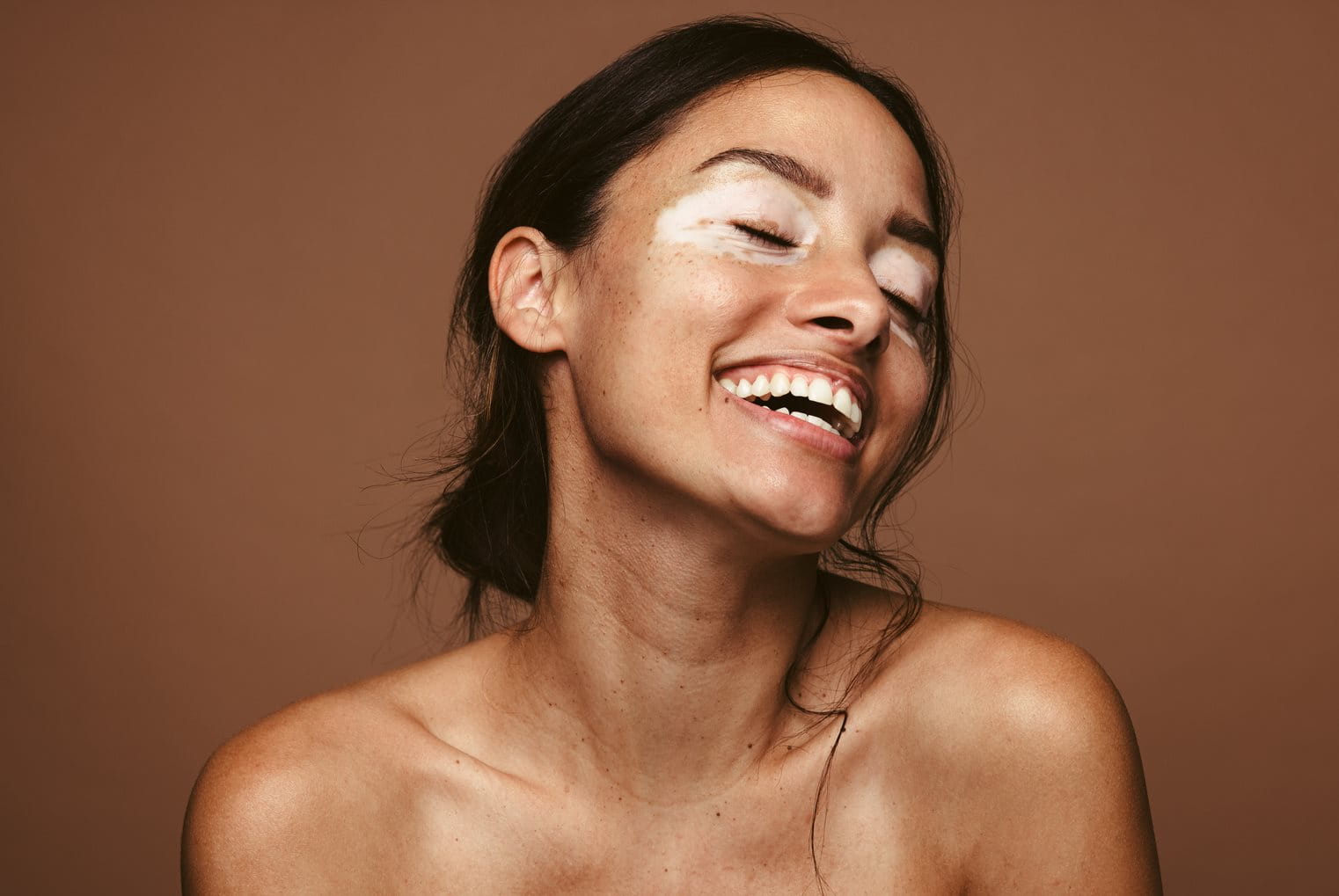 L'hypopigmentation survient lorsque la peau produit une quantité de mélanine inférieure à la normale.