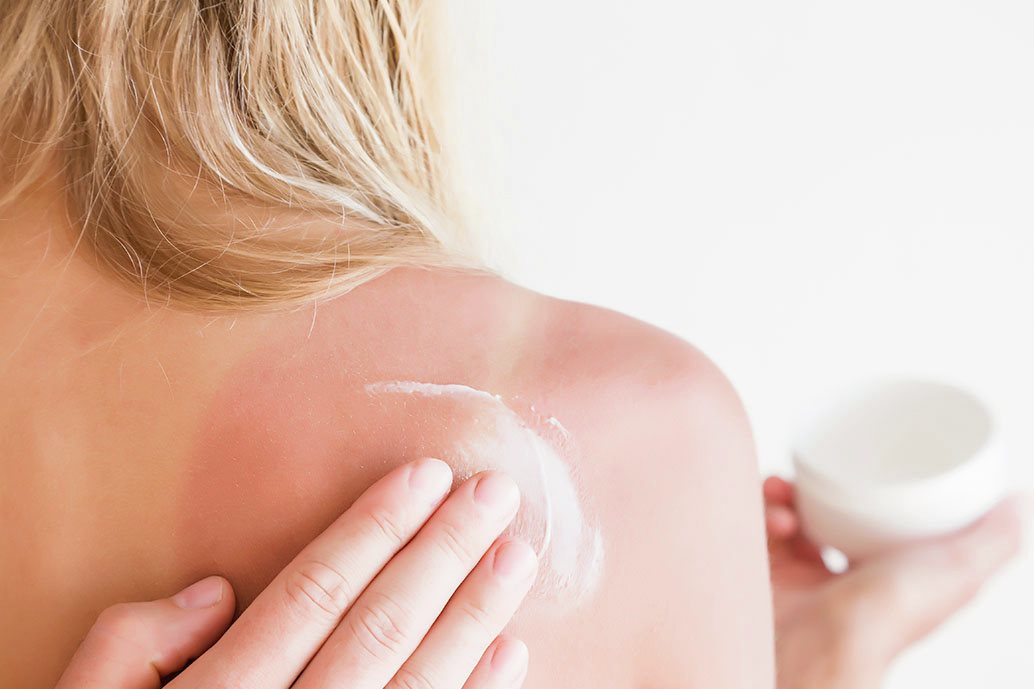 Crema lenitiva per alleviare i sintomi dell'orticaria solare