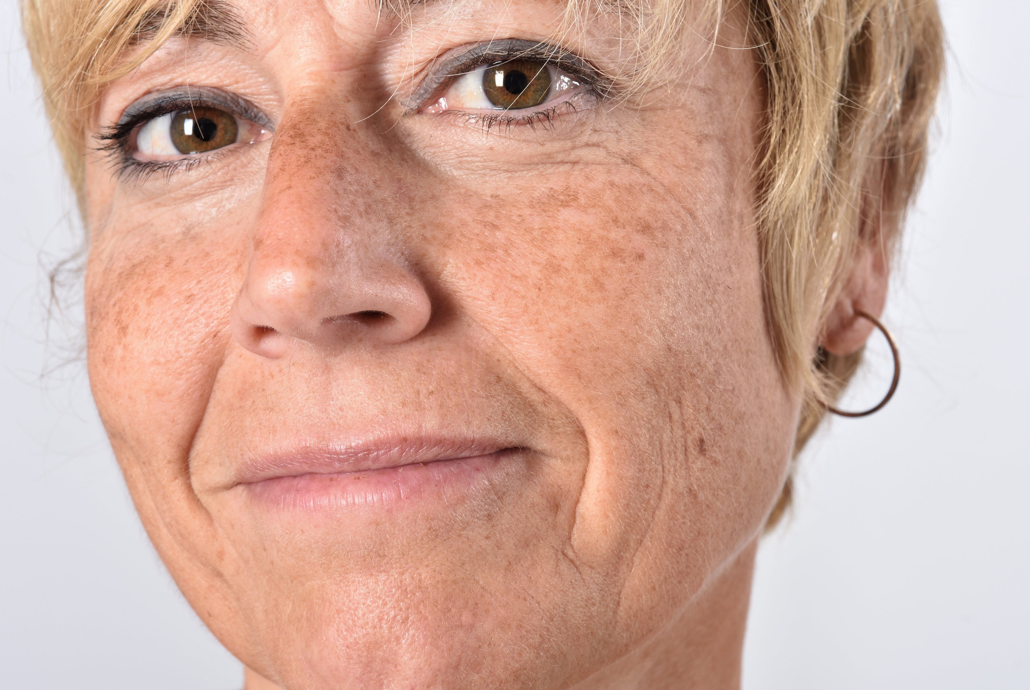 Eine kaukasische Frau mittleren Alters lächelt leicht in die Kamera. Auf Nasenrücken und Wangen sind Sommersprossen und Altersflecken zu sehen.