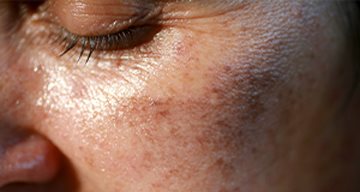 Frau mit Hyperpigmentierung im Gesicht