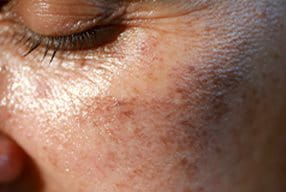Frau mit Hyperpigmentierung im Gesicht