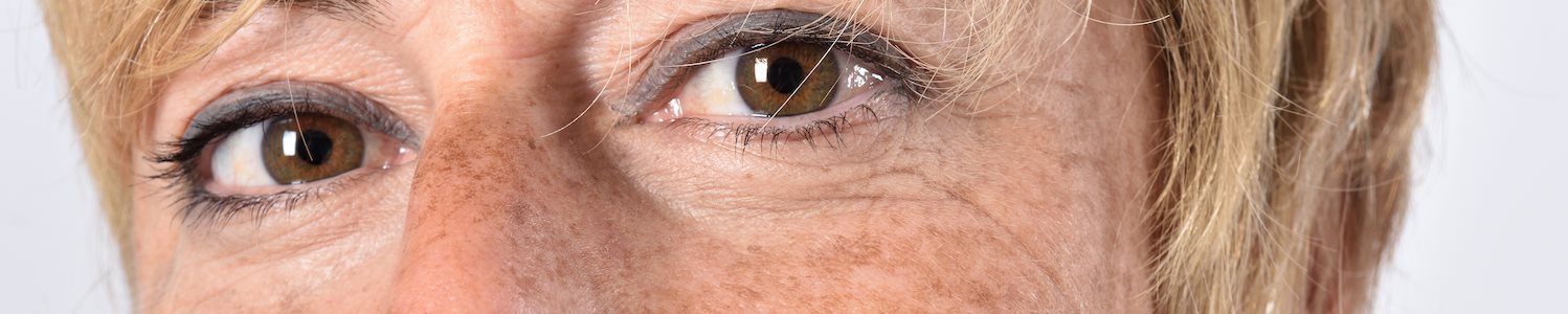 Eine kaukasische Frau mittleren Alters lächelt leicht in die Kamera. Auf Nasenrücken und Wangen sind Sommersprossen und Altersflecken zu sehen.