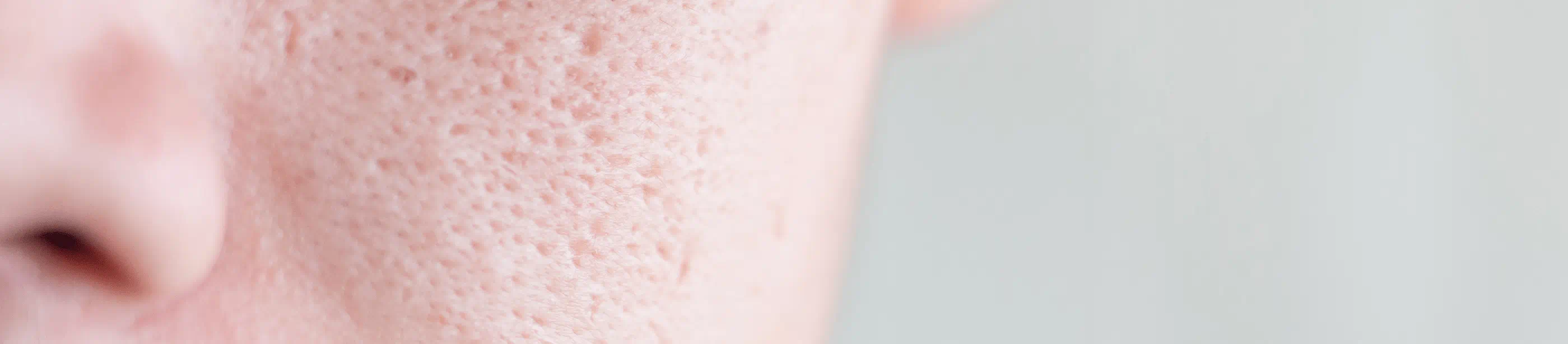 Close up of clogged pores