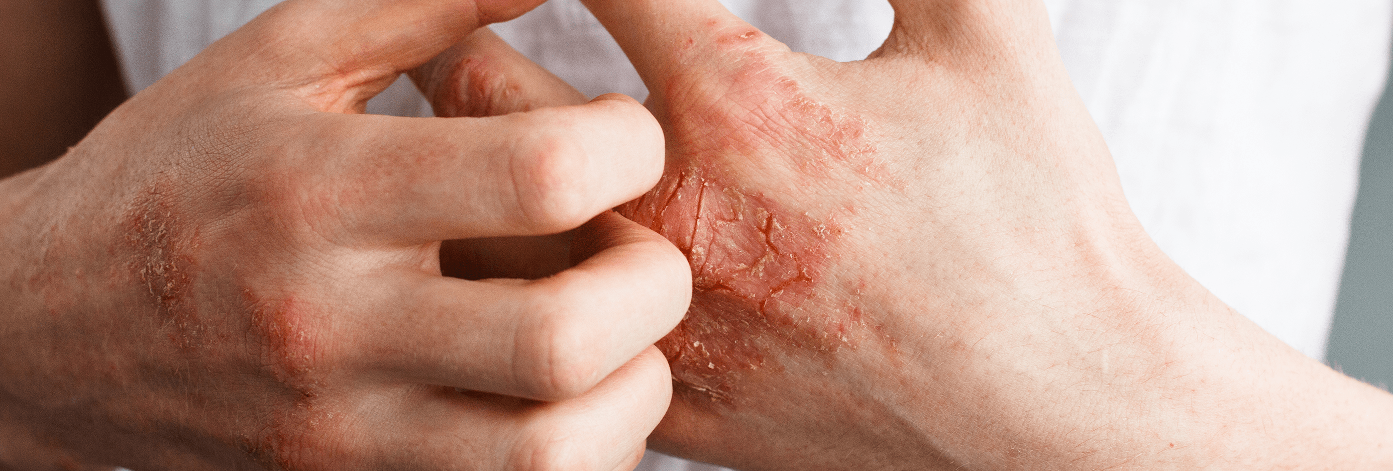  Eczema on hands