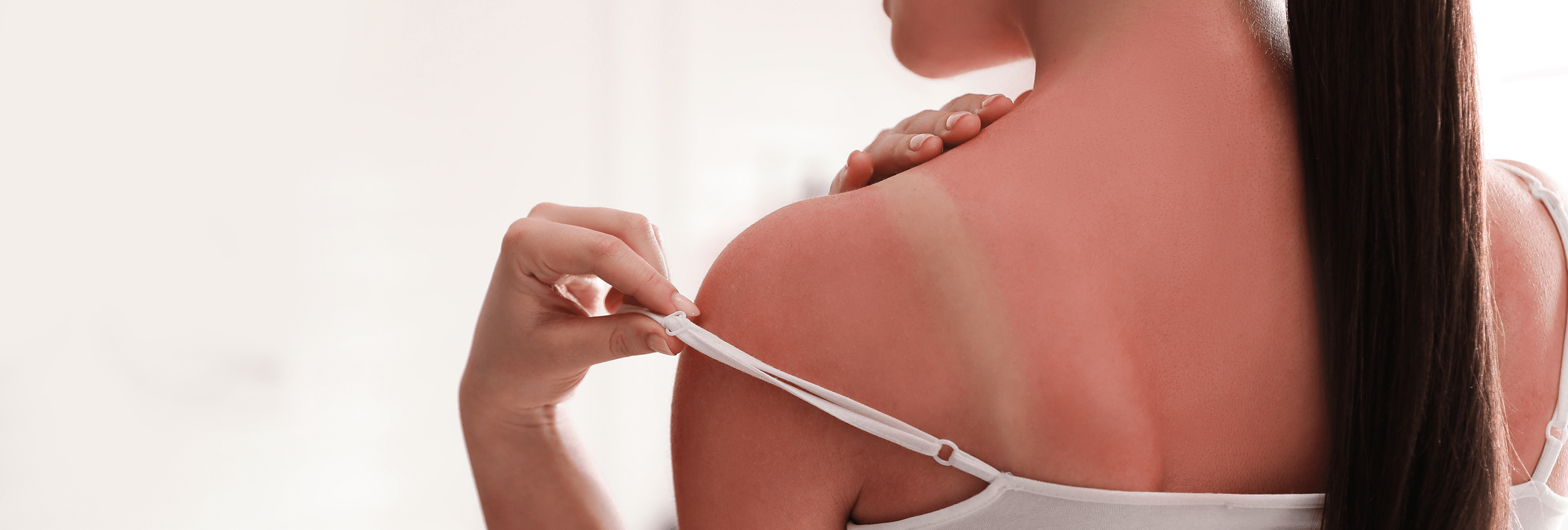 How to treat a sunburn - Reviewed