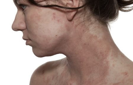 White skinned woman´s face and décolleté with Atopic Dermatitis