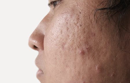Face close-up with acne