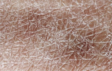 uvećani prikaz suhe kože