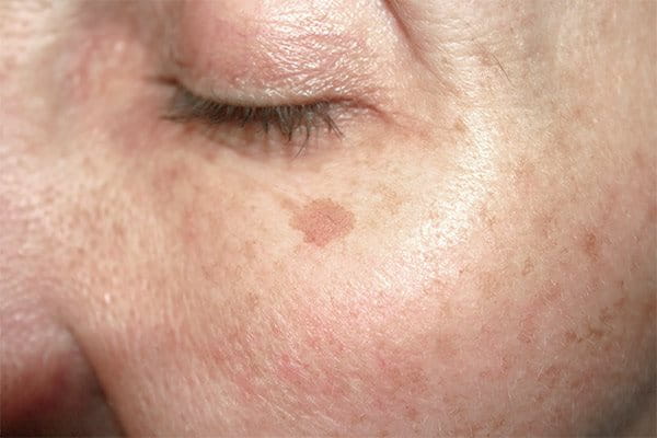 Старчески петна (познати още като слънчеви петна) се проявяват под формата на малки, плоски и тъмни петна по кожата.