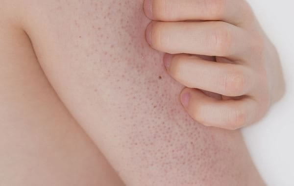 Keratosis Pilaris