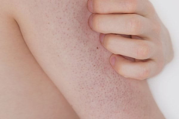 Появяват се малки червени, кафяви пъпки по тялото или такива с цвета на кожата. Едно от най-честите състояния е гъша кожа на ръцете.