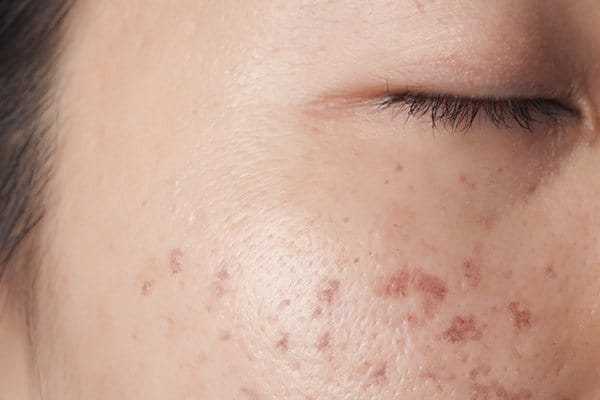 Ето какво се случва с кожата ви при PIH или постинфламаторна хиперпигментация