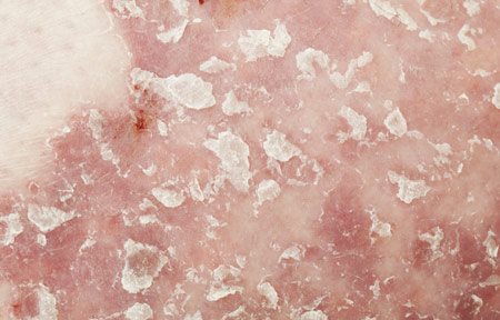 Bệnh vẩy nến là một bệnh ngoài da mãn tính, được định rõ đặc điểm bởi các 'mảng' màu hồng, xám, được phân ranh giới rõ ràng.