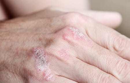 Hands with psoriasis