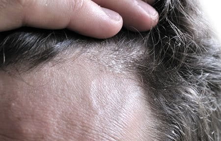 Man with yellowish scales on the scalp