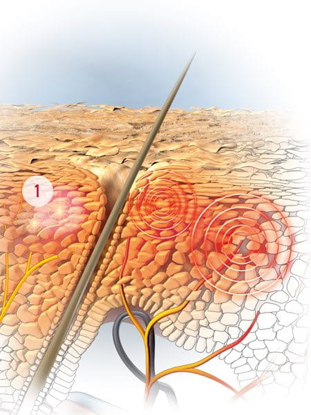 Illustration of microinflammation